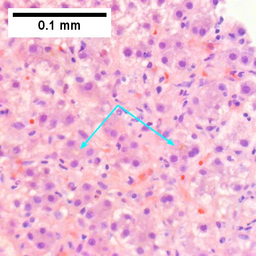 Rare distorted rosettes with greenish brown strands of bile (left arrow) or bile plugs (right arrow) (400X).