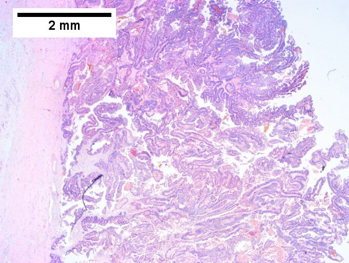 Intraductal papillary neoplasm of common bile duct with associated invasive carcinoma.