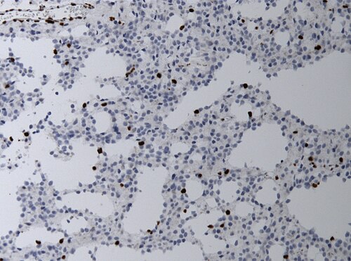 Neuropathology case II ATRX immunohistochemistry.jpg