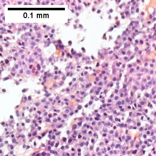 Tumor cells showed round to ovoid nuclei without pattern and with grey cytoplasm that proved to be CD138 positive (Row 2 Right 400X).
