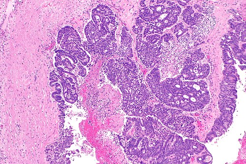 Metastatic adenocarcinoma involving the kidney -- low mag.jpg
