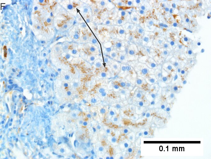 Alpha 1 anti-trypsin (A1AT) granules in cirrhosis, not due to A1AT deficiency; A1AT level was normal.