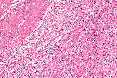 Adenomatoid tumour - intermed mag.jpg