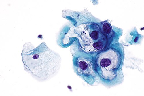 Low-grade squamous intraepithelial lesion - 3 -- very high mag.jpg