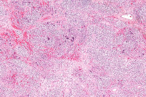 Seminoma with syncytiotrophoblasts - low mag.jpg