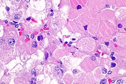 Eosinophilic, solid and cystic renal cell carcinoma - 3 -- very high mag.jpg