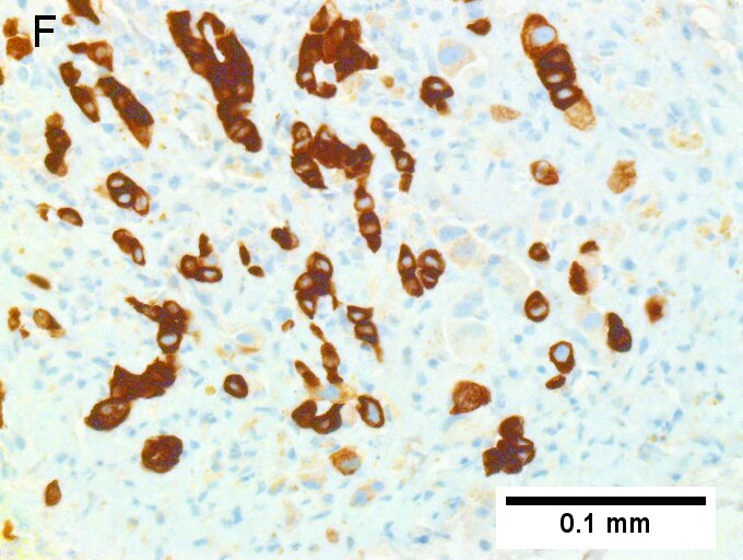 Cholangiocarcinoma with associated abscess