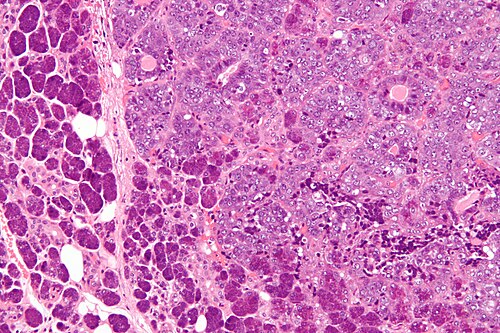 Epithelial-myoepithelial carcinoma - high mag.jpg