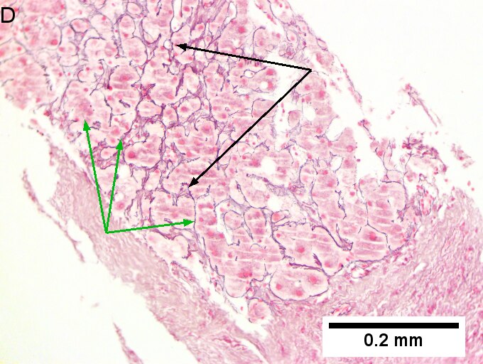 Alpha 1 anti-trypsin (A1AT) granules in cirrhosis, not due to A1AT deficiency; A1AT level was normal.