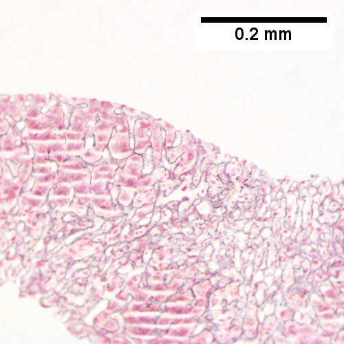 Submassive hepatic necrosis.