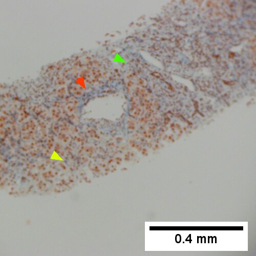 Trichrome shows central venous sclerosis (red arrowhead), periportal fibrosis (green arrowhead), & space of Disse collagenization (yellow arrowhead); juxtaposition of central vein & portal tract indicates collapse, no definite bridging was seen (100X)