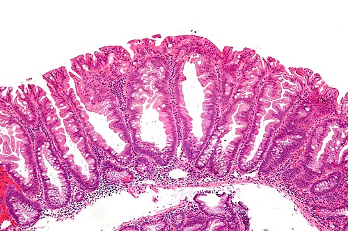 Sessile serrated adenoma 2 intermed mag.jpg