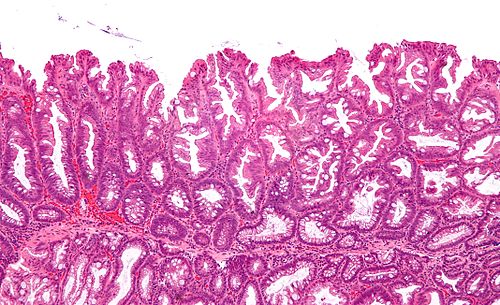Sessile serrated adenoma 3 intermed mag.jpg