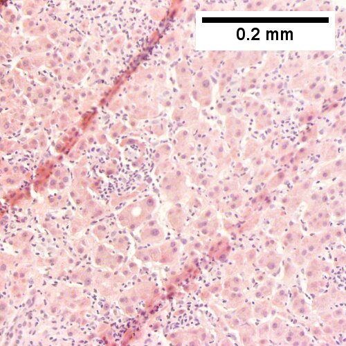Apparent lobular infiltrate with small masse.