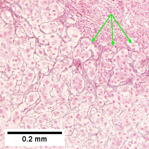 Hepatitis C. Metavir Activity Index 2 (PMN2, LN1), Metavir fibrosis stage 3