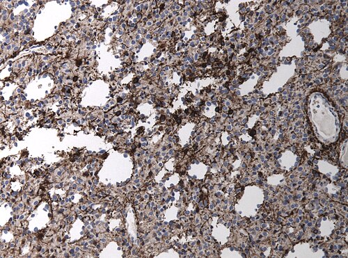 Neuropathology case II 06.jpg
