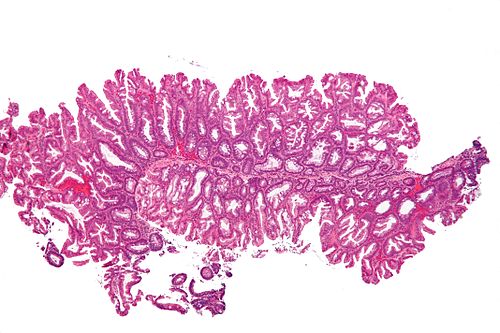 Sessile serrated adenoma 3 low mag.jpg